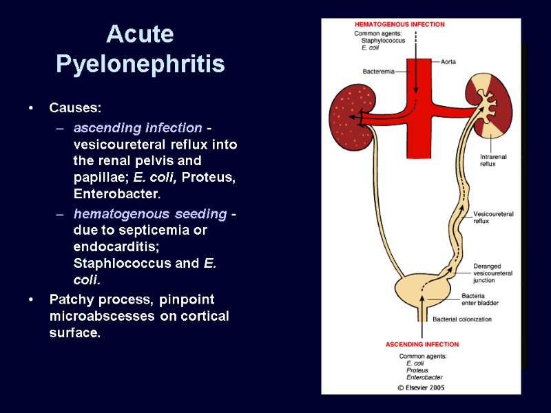 Acute Pyelonephritis Causes: ascending infection - vesicoureteral reflux into the renal pelvis and papillae;